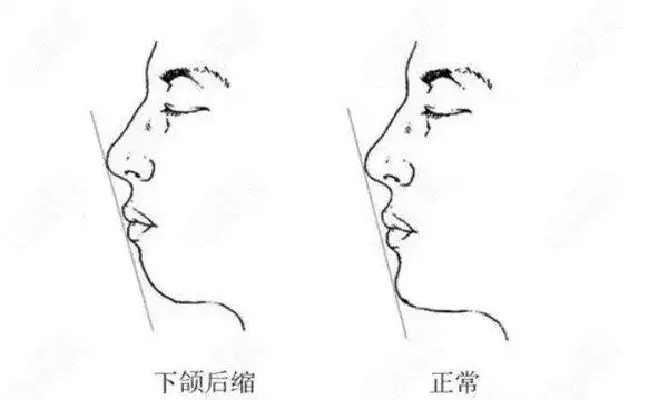 骨性下巴后缩做正颌还是颏成型手术呢