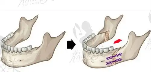 正颌手术示意图