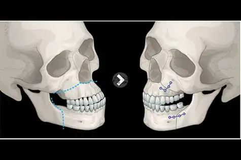 双鄂手术和正颌手术的区别是什么 哪种改善效果大