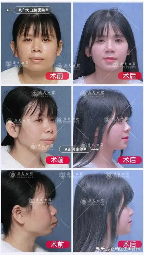 正颌手术丨嘴巴凸下巴后缩根尖下截骨拔掉4颗牙后它变成这样