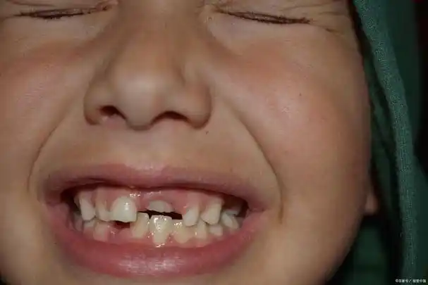 孩子咬手指会导致龅牙吗?了解影响口腔健康的不良习惯