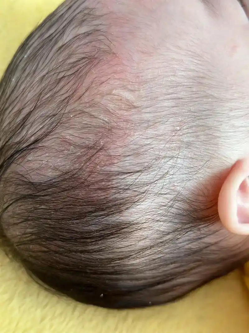 宝宝头垢    脂溢性皮炎