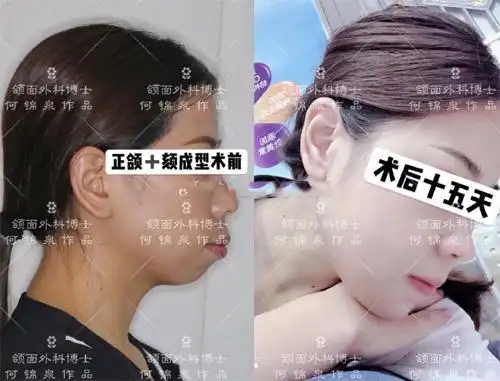 正颌骨手术千万别去做?那是因为你没有做到这几点!